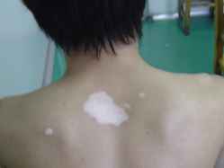 白癜风病因