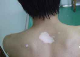 儿童腿部白癜风怎么治疗好