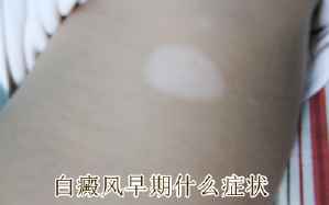 如何治白癜风才科学